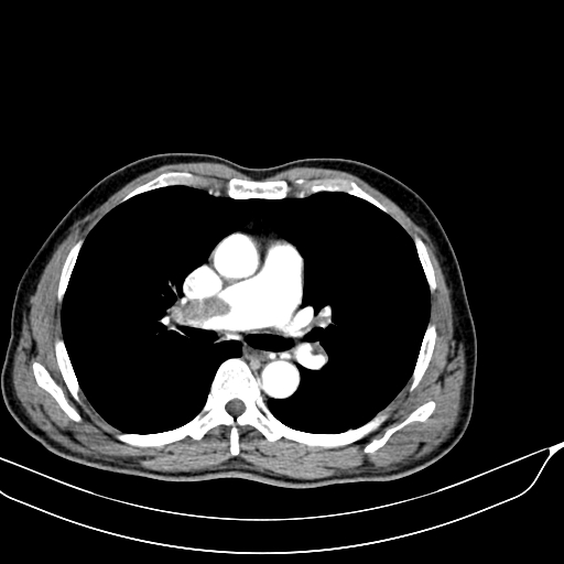 Acute pulmonary embolism (Radiopaedia 69510-79390 D 4).jpg
