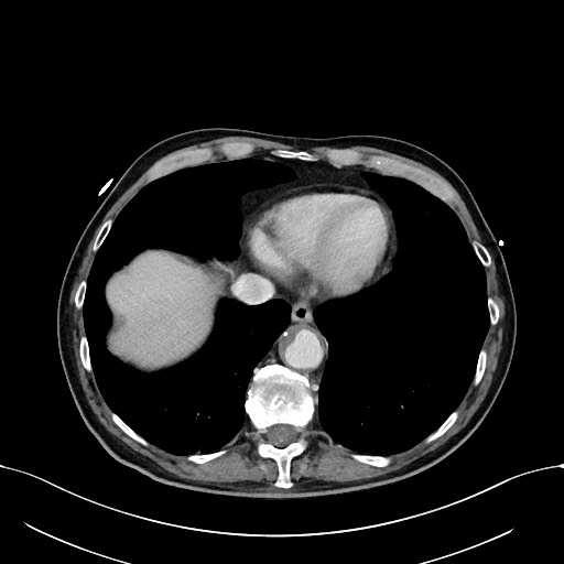 Acute renal infarction (Radiopaedia 59375-66736 Axial C+ portal venous phase 6).jpg