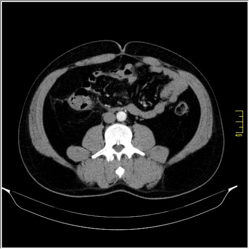 File:Acute right sided diverticulitis (Radiopaedia 65249-74268 Axial C+ portal venous phase 41).JPG