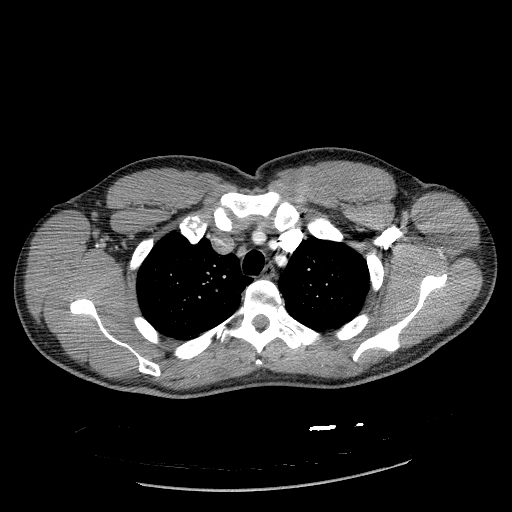 File:Acute segmental pulmonary emboli and pulmonary infarction (Radiopaedia 62264-70444 Axial C+ CTPA 28).jpg