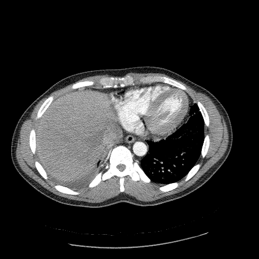 Acute segmental pulmonary emboli and pulmonary infarction (Radiopaedia 62264-70444 Axial C+ CTPA 90).jpg