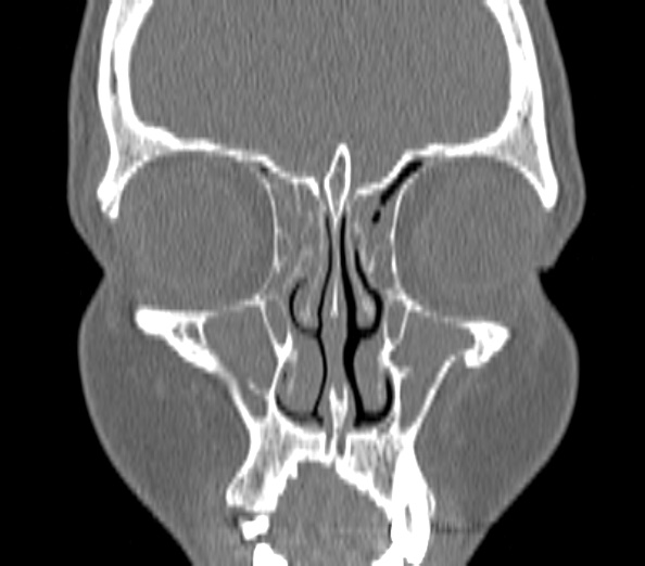 Acute sinusitis (Radiopaedia 40564-43158 Coronal bone window 10).jpg