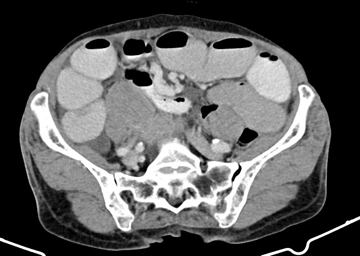 Acute small bowel (ileal) volvulus (Radiopaedia 71740-82139 Axial C+ portal venous phase 145).jpg