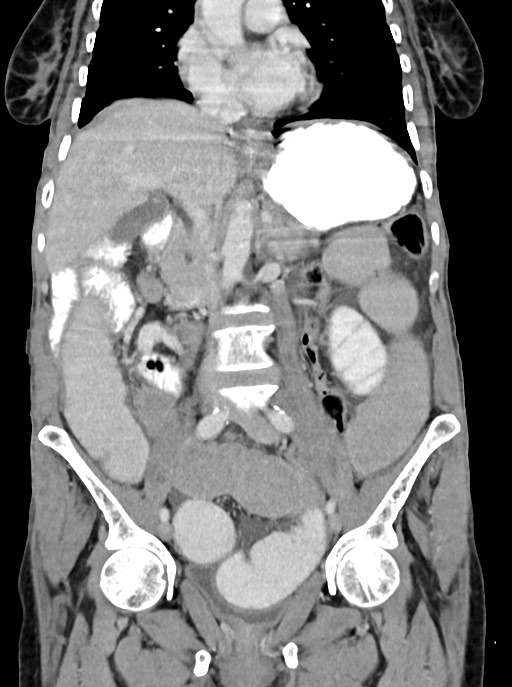 Acute small bowel (ileal) volvulus (Radiopaedia 71740-82139 Coronal C+ portal venous phase 56).jpg