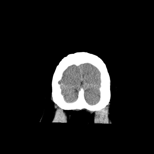 Acute subarachnoid hemorrhage and accessory anterior cerebral artery (Radiopaedia 69231-79008 Coronal non-contrast 66).jpg