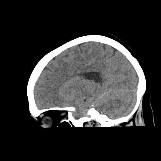 Acute subarachnoid hemorrhage and accessory anterior cerebral artery (Radiopaedia 69231-79008 Sagittal non-contrast 24).jpg