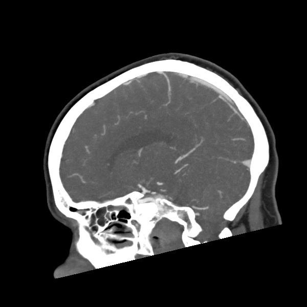 File:Acute subarachnoid hemorrhage and accessory anterior cerebral artery (Radiopaedia 69231-79009 Sagittal C+ arterial phase 33).jpg
