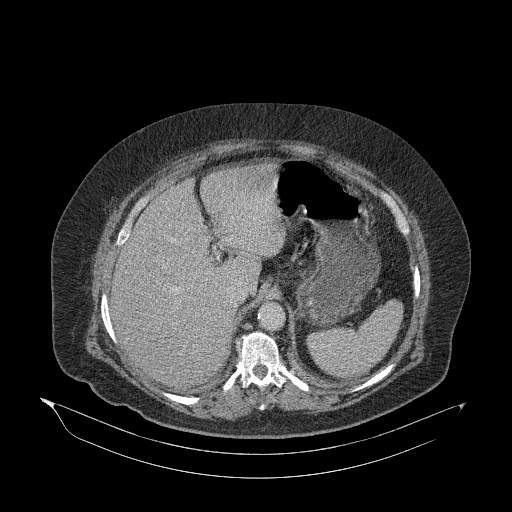 Acute superior mesenteric artery occlusion (Radiopaedia 51288-56960 Axial C+ portal venous phase 23).jpg