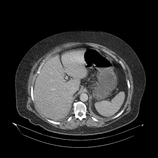 File:Acute superior mesenteric artery occlusion (Radiopaedia 51288-56960 Axial C+ portal venous phase 24).jpg