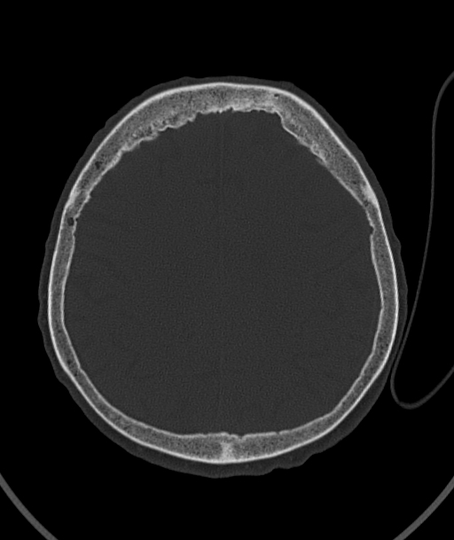 Acute traumatic subdural hematoma (Radiopaedia 82921-97257 Axial bone window 37).jpg