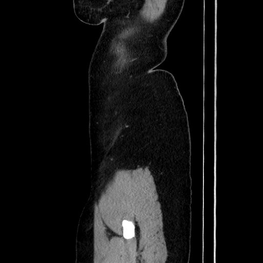 Acute uncomplicated appendicitis (Radiopaedia 73704-84499 Sagittal C+ portal venous phase 42).jpg