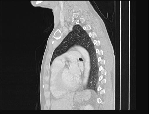Addison disease (Radiopaedia 49318-54412 Sagittal lung window 25).jpg