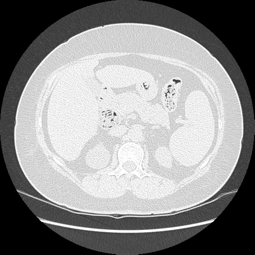 Adenocarcinoma in situ of lung (Radiopaedia 38685-40829 B 235).png