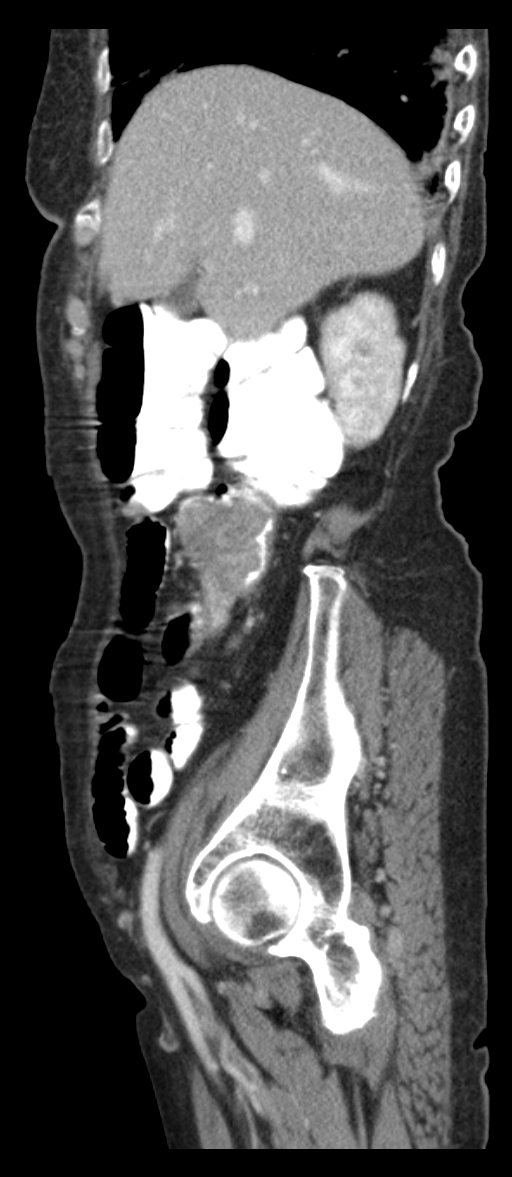 Adenocarcinoma of cecum (Radiopaedia 59222-66549 Sagittal C+ portal venous phase 75).jpg