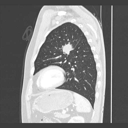 Adenocarcinoma of the lung (Radiopaedia 59871-67325 Sagittal lung window 77).jpg