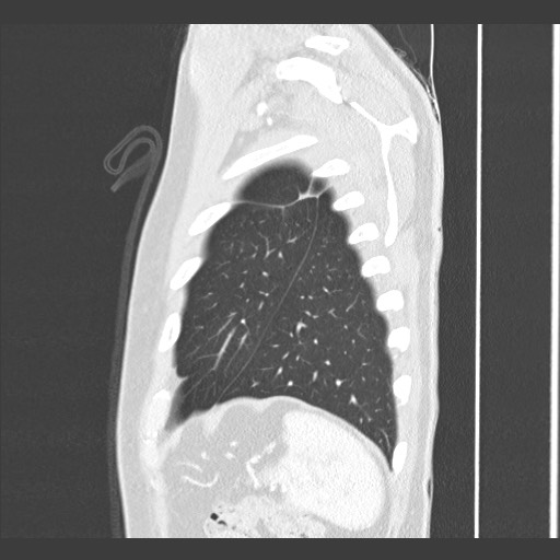 Adenocarcinoma of the lung (Radiopaedia 59871-67325 Sagittal lung window 89).jpg