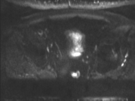 Adenocarcioma of rectum- T1 lesion (Radiopaedia 36921-38546 Axial DWI 17).png