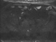 Adenocarcioma of rectum- T1 lesion (Radiopaedia 36921-38546 Axial DWI 58).png