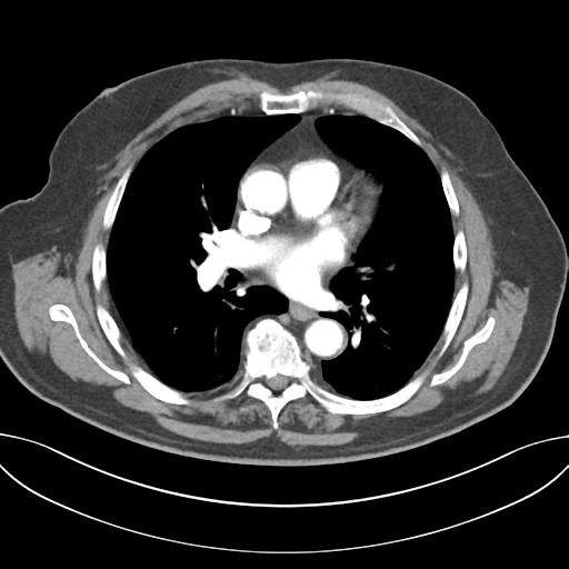 Adenocarcioma of rectum- T1 lesion (Radiopaedia 36921-38547 Axial C+ arterial phase 30).png