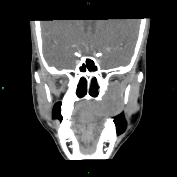 File:Adenoid cystic carcinoma of hard palate (Radiopaedia 26137-26273 Coronal liver window 14).jpg