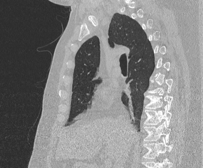 File:Adenoid cystic carcinoma of the trachea (Radiopaedia 49042-54137 Sagittal lung window 204).jpg