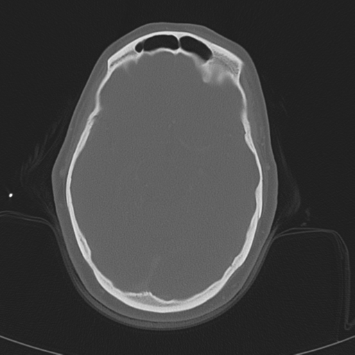 Adenoid cystic tumor of palate (Radiopaedia 46980-51518 Axial bone window 6).png