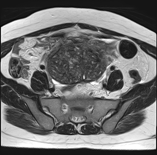 File:Adenomyosis - ovarian endometriomas (Radiopaedia 67031-76350 Axial T2 8).jpg