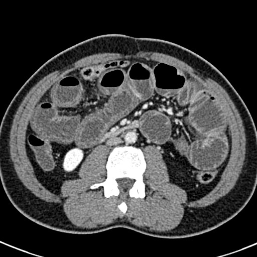 Adhesional small bowel obstruction (Radiopaedia 58900-66131 Axial C+ portal venous phase 26).jpg