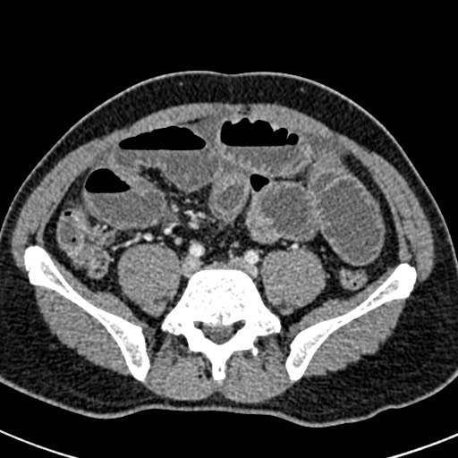 Adhesional small bowel obstruction (Radiopaedia 58900-66131 Axial C+ portal venous phase 36).jpg
