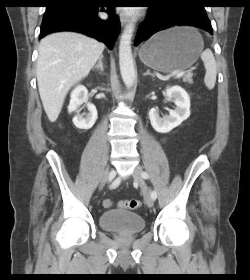 File:Adhesions within abdominal wall hernia (Radiopaedia 58283-65394 Coronal C+ portal venous phase 43).png