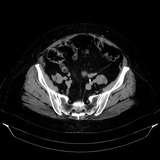 Adrenal cortical carcinoma (Radiopaedia 64017-72769 Axial C+ delayed 60).jpg