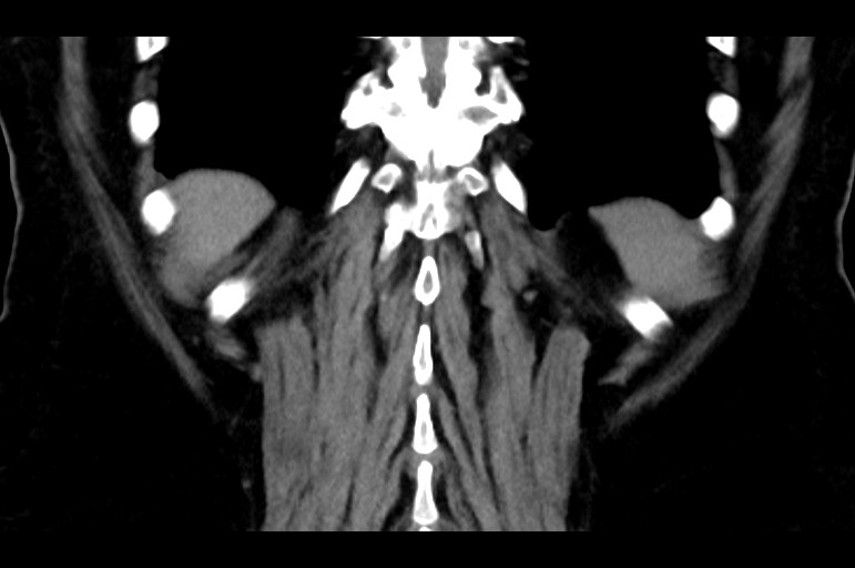 Adrenal cortical carcinoma (Radiopaedia 64017-72769 Coronal non-contrast 48).jpg