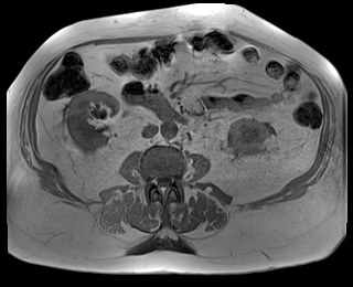 File:Adrenal cortical carcinoma (Radiopaedia 64017-72770 Axial T1 in-phase 53).jpg