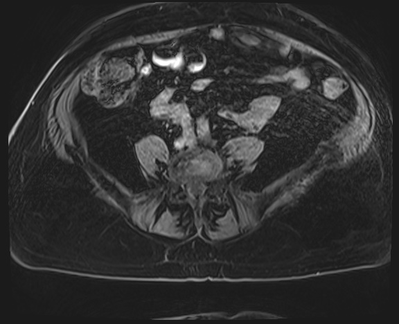 Adrenal cortical carcinoma (Radiopaedia 64017-72770 H 58).jpg