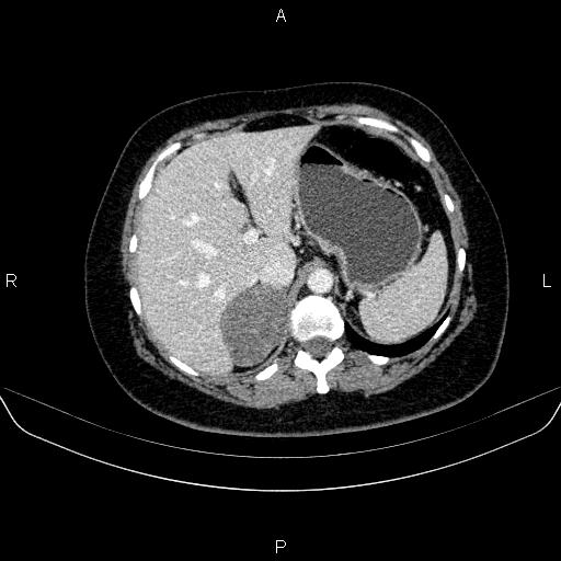 File:Adrenal cortical carcinoma (Radiopaedia 84882-100379 Axial C+ portal venous phase 20).jpg