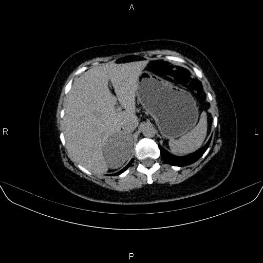 File:Adrenal cortical carcinoma (Radiopaedia 84882-100379 Axial non-contrast 20).jpg