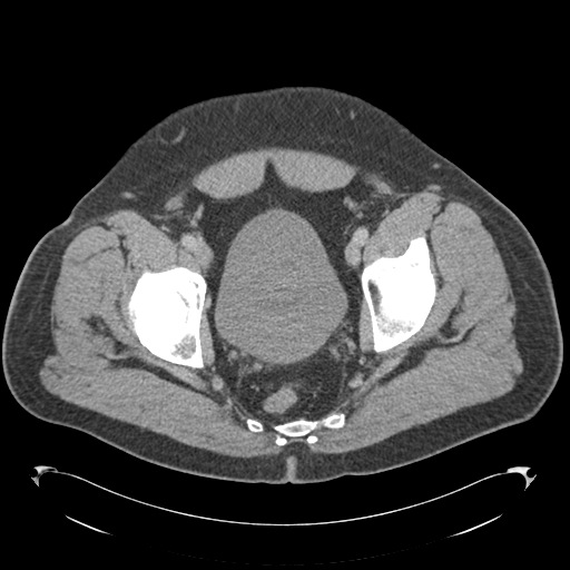 Adrenal cyst (Radiopaedia 45625-49776 Axial C+ portal venous phase 89).png