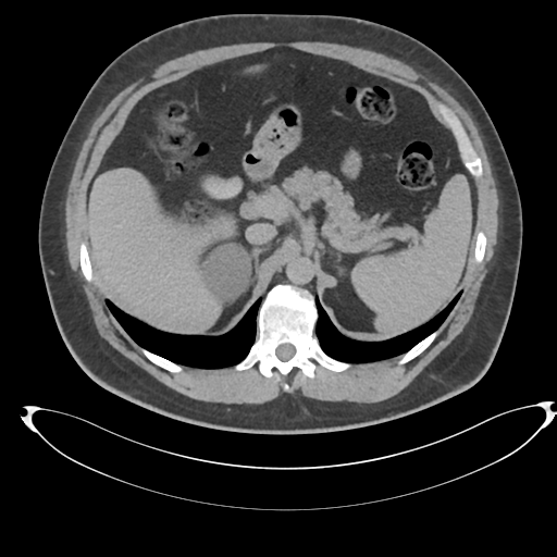 Adrenal cyst (Radiopaedia 45625-49778 AXIAL THICK 15 min 18).png