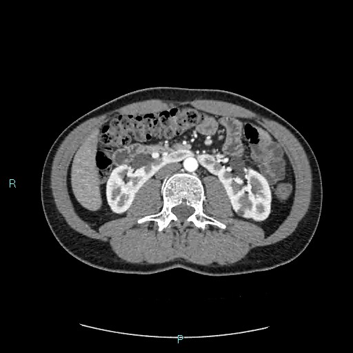 Adrenal cystic lymphangioma (Radiopaedia 83161-97534 Axial C+ arterial phase 46).jpg
