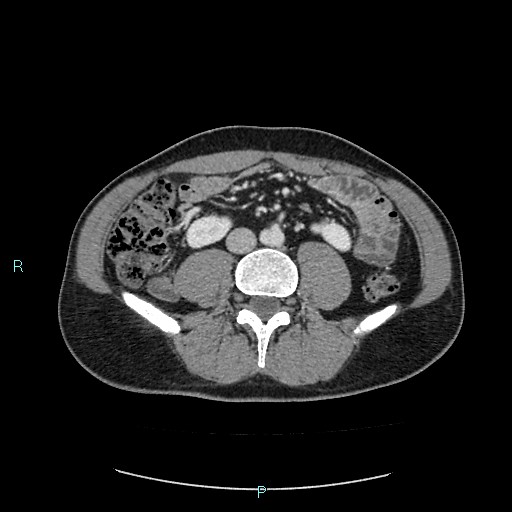 Adrenal cystic lymphangioma (Radiopaedia 83161-97534 Axial C+ portal venous phase 58).jpg
