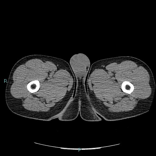 Adrenal cystic lymphangioma (Radiopaedia 83161-97534 Axial non-contrast 119).jpg