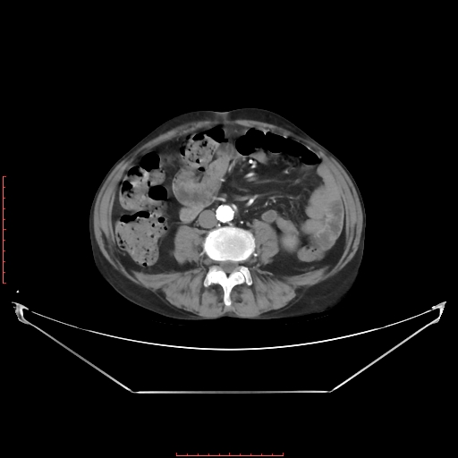Adrenal hemangioma (Radiopaedia 68923-78668 Axial C+ arterial phase 44).jpg
