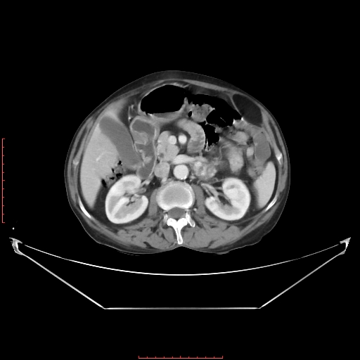 Adrenal hemangioma (Radiopaedia 68923-78668 Axial C+ portal venous phase 31).jpg
