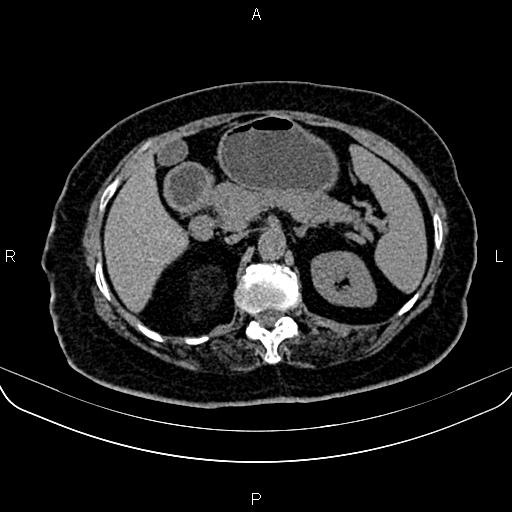 Adrenal myelolipoma (Radiopaedia 82742-96986 Axial non-contrast 51).jpg