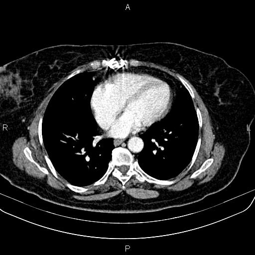File:Adrenal myelolipoma (Radiopaedia 82742-96986 Axial renal cortical phase 1).jpg