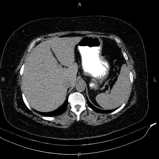 Adrenal myelolipoma (Radiopaedia 84319-99617 Axial With oral contrast 50).jpg