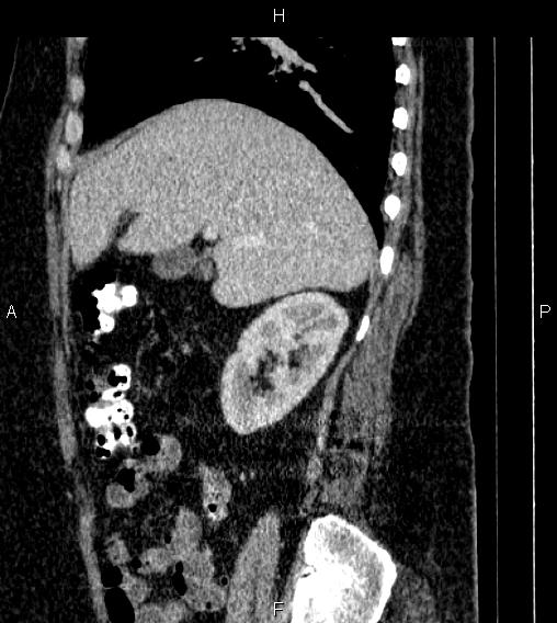 Adrenal myelolipoma (Radiopaedia 84319-99617 Sagittal renal cortical phase 28).jpg