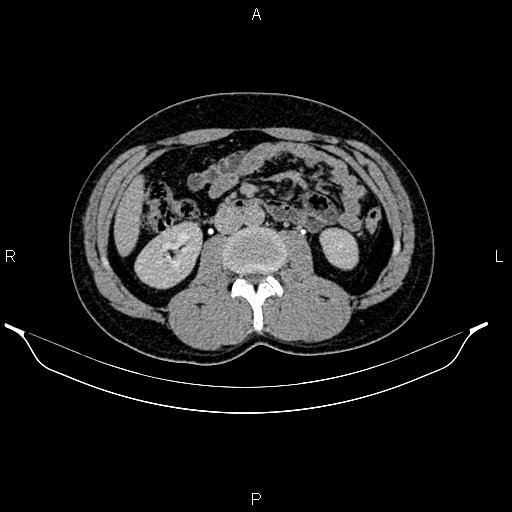 Adrenal myelolipoma (Radiopaedia 87794-104246 Axial renal excretory phase 49).jpg