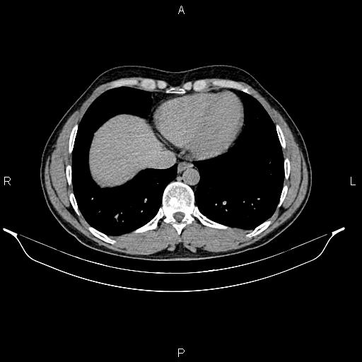 Adrenal myelolipoma (Radiopaedia 87794-104246 Axial renal excretory phase 9).jpg