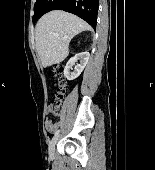 Adrenal myelolipoma (Radiopaedia 87794-104246 Sagittal renal cortical phase 26).jpg